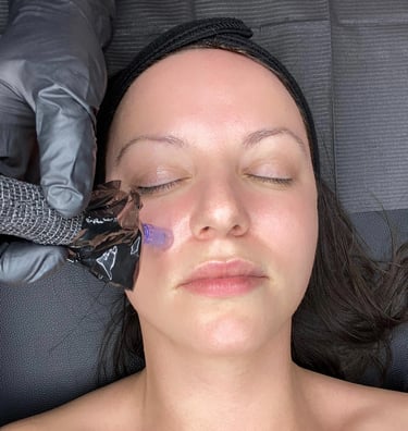 seance de microneedling, aiguille microneedling