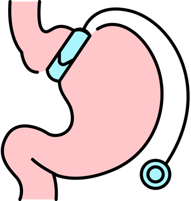 Gyomor-gyűrű eltávolítás