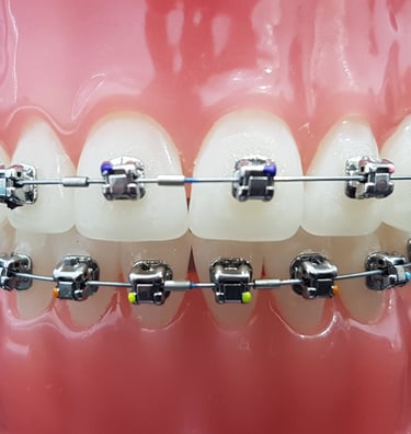 Kawat gigi modern di Sidharta Dental Studio Malang untuk perawatan gigi yang rapi dan nyaman