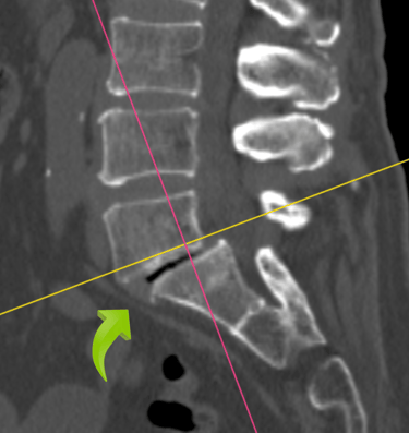Espondilolistesi lumbar, listesis anterior, dr tafur, artrodesis lumbar