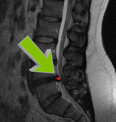 Hernia lumbar, dr tafur, cirugia de columna, mejor neurocirujano