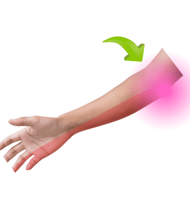 sindrome de tunel cubital, medico neurocirujano, dolor, nervio perifericos
