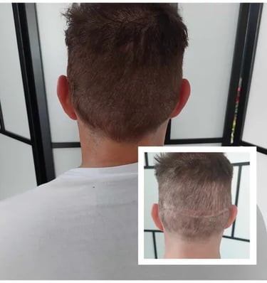 Micropigmentation, camouflage de cicatrice. Tricopigmentation, pigmentation capillaire
