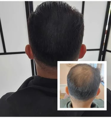 Micropigmentation, effet densité. Tricopigmentation, pigmentation capillaire