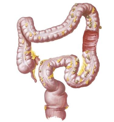 Medical illustration of a human colon with diverticulosis showing small bulging pouches.