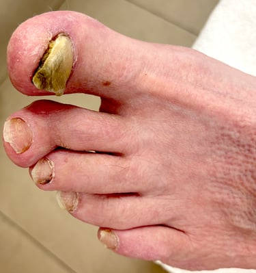Before image of Toe Nail Fungus client, Boise Idaho