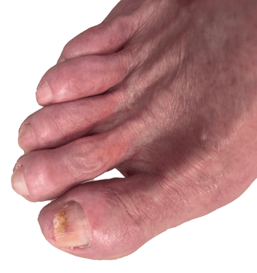 Toe Nail Fungus of client after recieving a Medical Pedicure in Boise Idaho