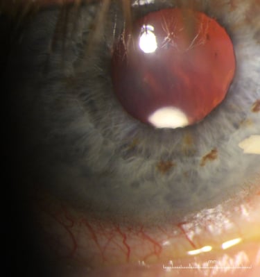 Alloflo scleral implant