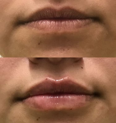 preenchimento de boca