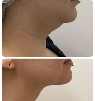 procedimento de papada