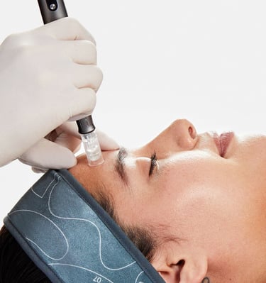 Microneedling treatment targeting fine lines and enlarged pores