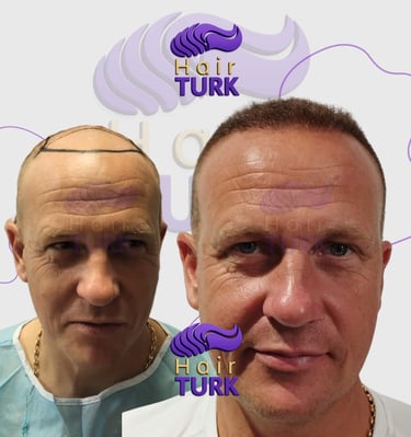 Hair transplant clinic in turkey before after