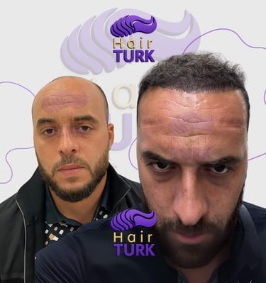 Hair transplant clinic in turkey before after