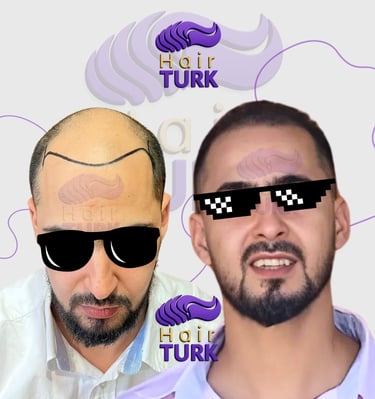 Hair transplant clinic in turkey before after