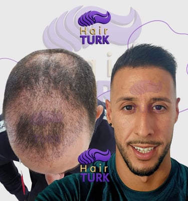 Hair transplant clinic in turkey before after