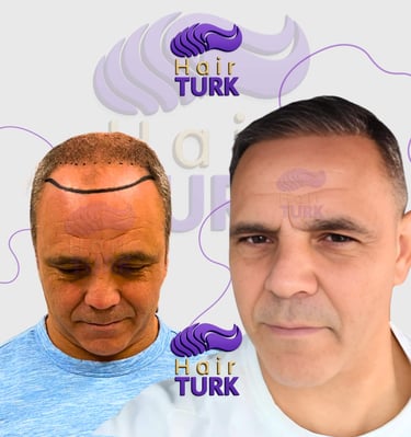 Hair transplant clinic in turkey before after