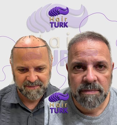 Hair transplant clinic in turkey before after
