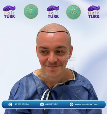 Patient avant sa greffe de cheveux, présentant une alopécie de grade V