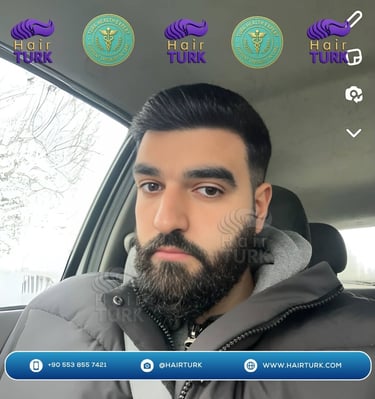 Même patient 10 mois après sa greffe de 3600 greffons, avec une ligne frontale restaurée.