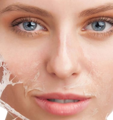 peeling químico vitoria Gasteiz 