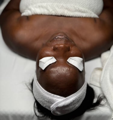 Chemical Peels to brighten and control hyperpigmentation.