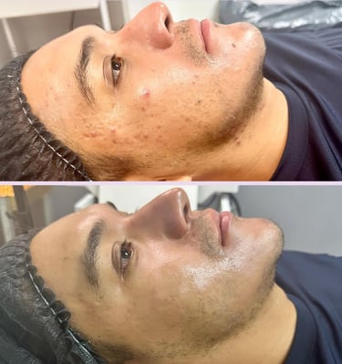 antes y despues de tratamiento facial en hombre
