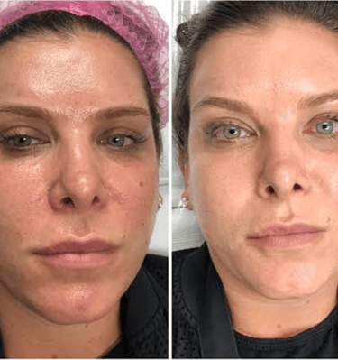 antes y despues de tratamiento facil en mujer