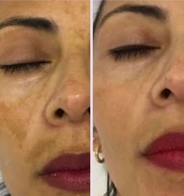 antes y despues de tratamiento facial en señora