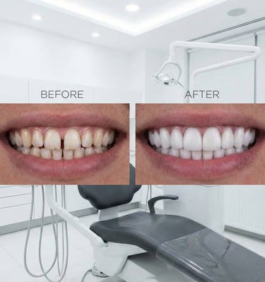 Hollywood Smile - Veneer