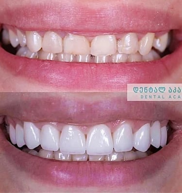 Before and after dental veneers transformation in Tbilisi clinic