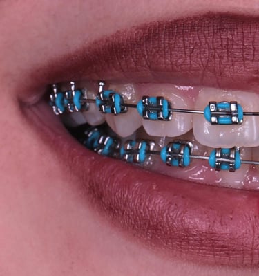 Young woman smiling during orthodontic braces treatment in Tbilisi dental clinic