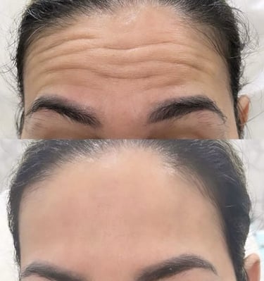 Reduccion de arrugas y lineas de expresion