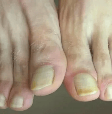 Grybelio pažeistų nagų pedikiūras​ 2255