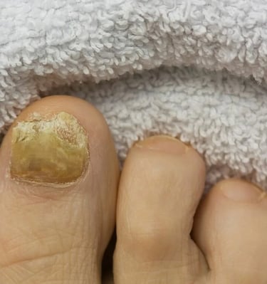 Grybelio pažeistų nagų pedikiūras​ 0145