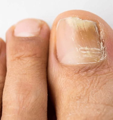 Grybelio pažeistų nagų pedikiūras​ 4522