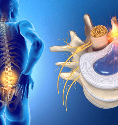 protrusion o hernia discal