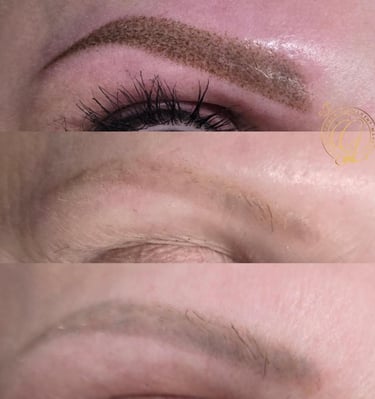 first picture where done elsewhere, second picture we did laser removal, top done by us