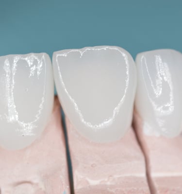 Corona de zirconia en dientes anteriores