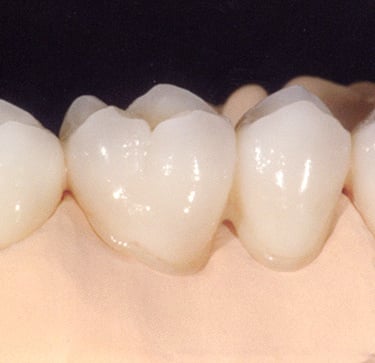 Corona de zirconia en molar