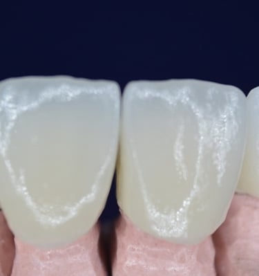 Coronas de zirconia dientes centrales