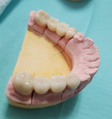 Coronas y puentes de zirconia
