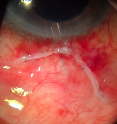 Ahmed shunt wount 7x7mm