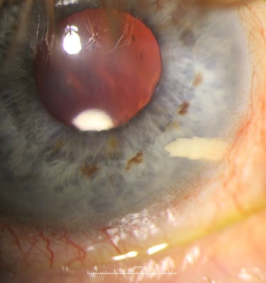Alloflo scleral implant