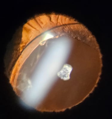 Dislocated Intraocular Lens