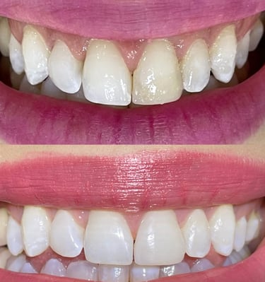 lente de contato nos dentes