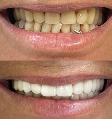 Implante de dente em Coqueiral de Itaparica