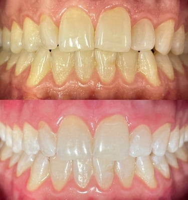 Clareamento de dente em Vila Velha