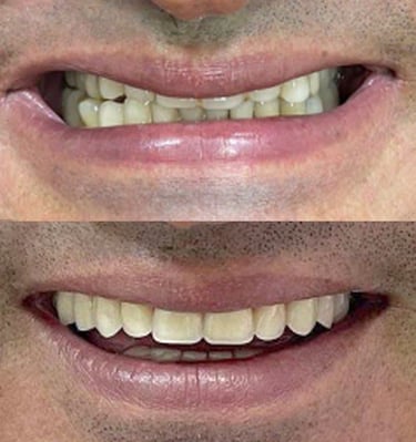 prótese dentária em Coqueiral de Itaparica