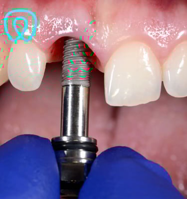 Implante dental