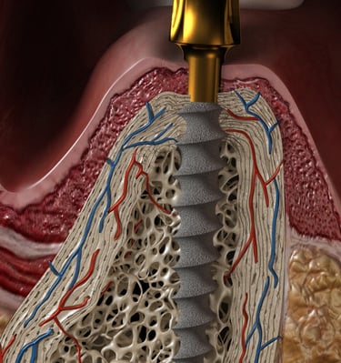 IMPLANTE MONOBLOQUE IDEAL PACIENTES CON POCO HUESO